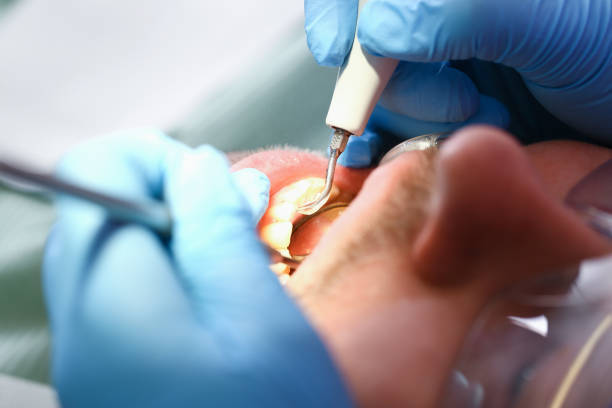 Best Emergency Tooth Extraction in Quincy, IL